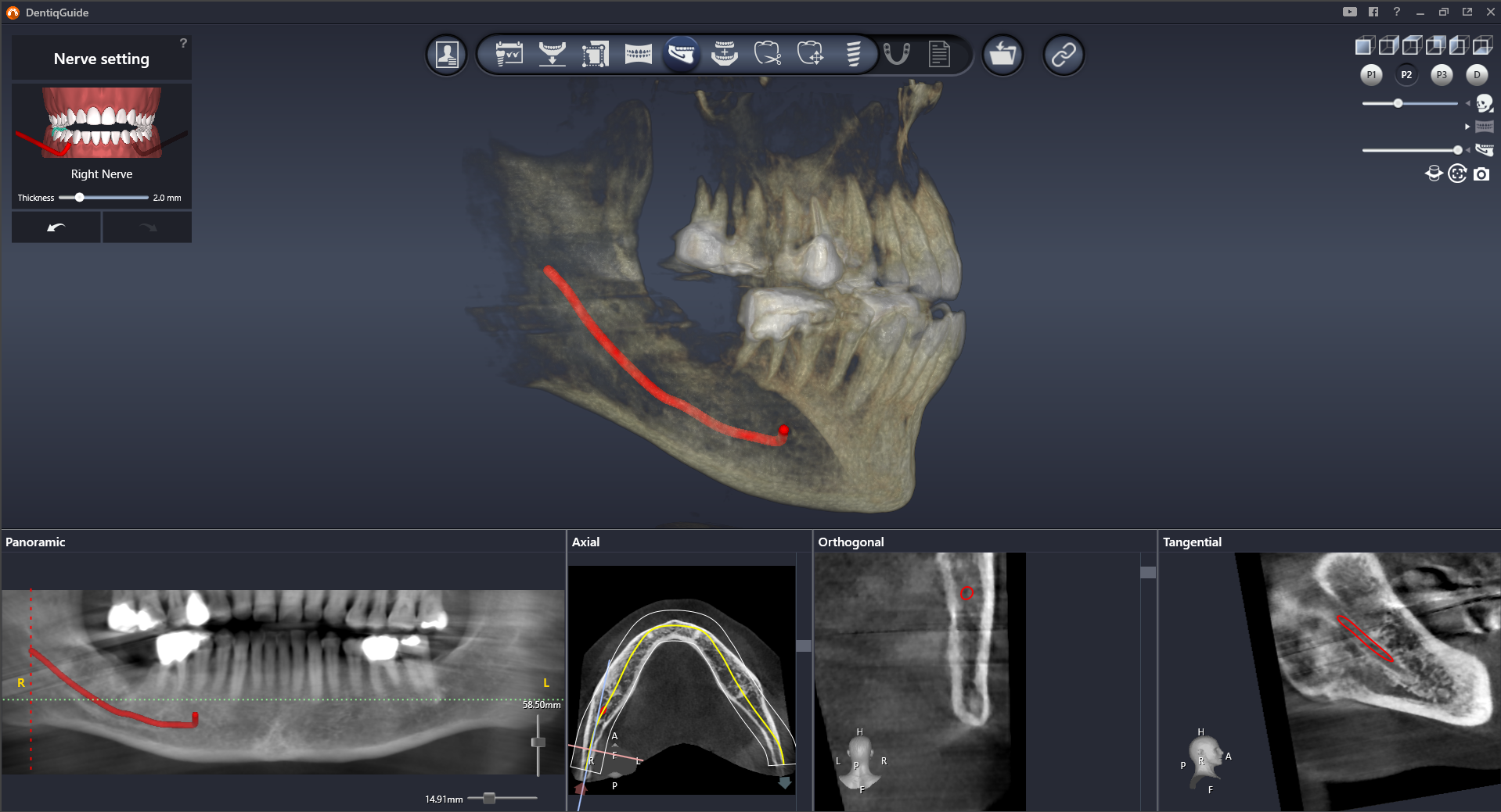 Nerve Canal Detection