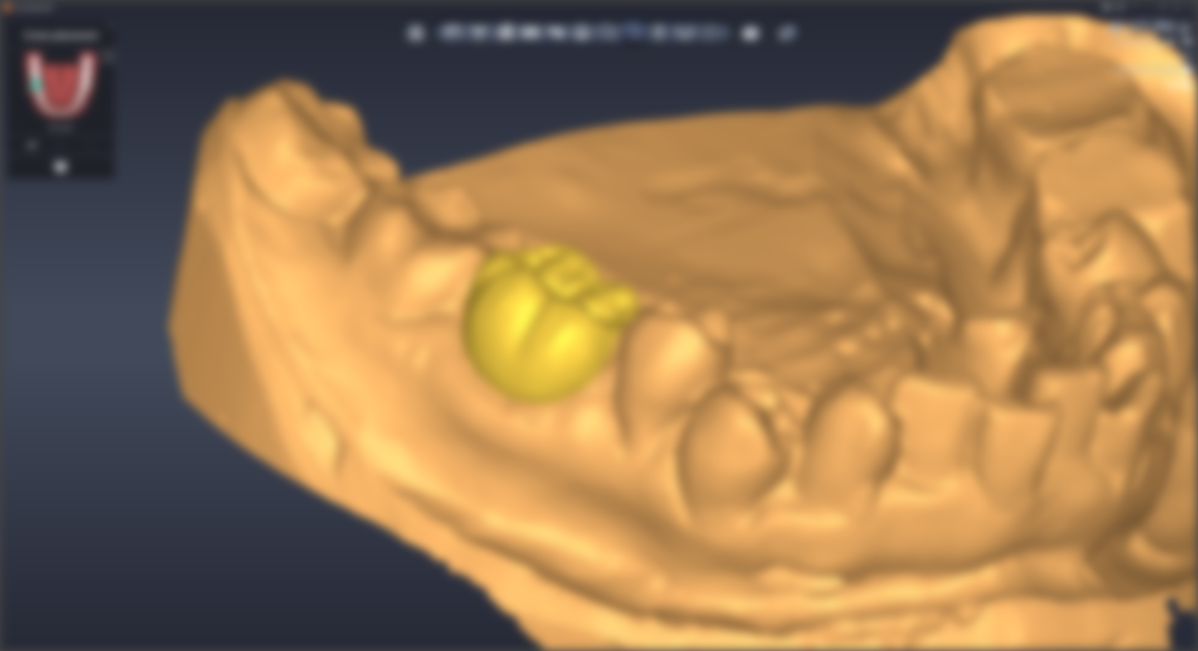 Tooth Placement