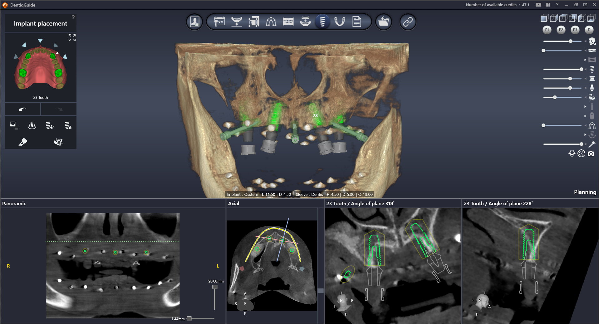 DentiqGuide Interface 1