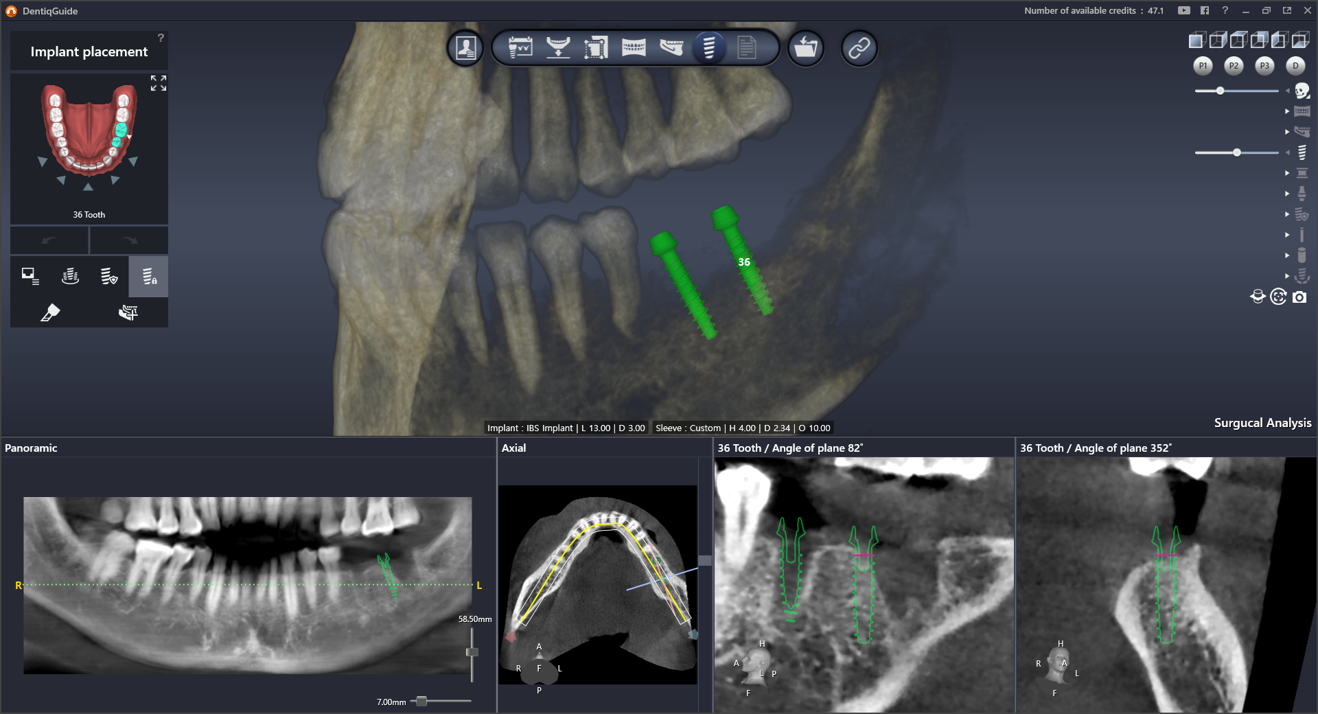 DentiqGuide Interface 3