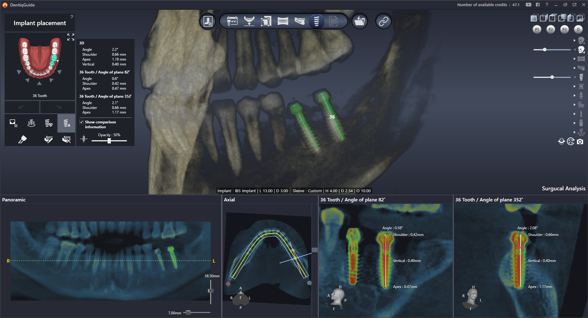 DentiqGuide Interface 4