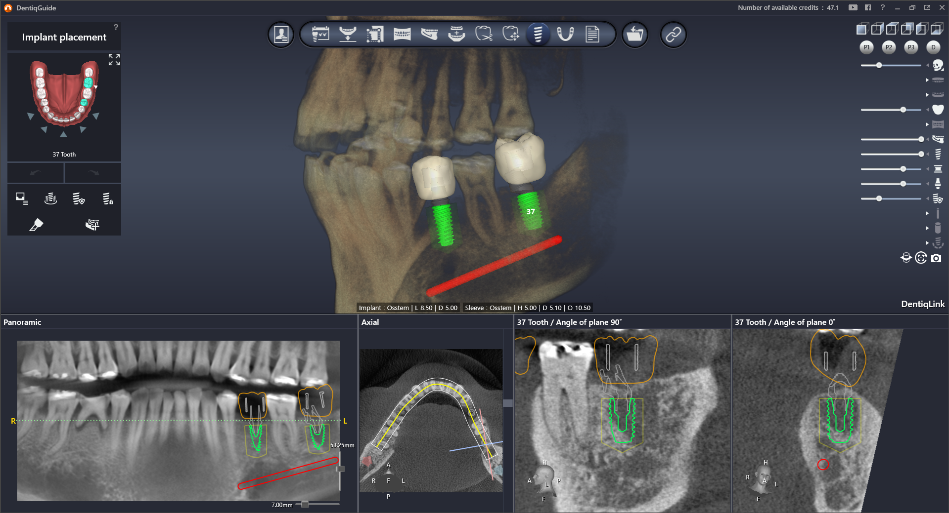 Easy and precise implant planning with AI